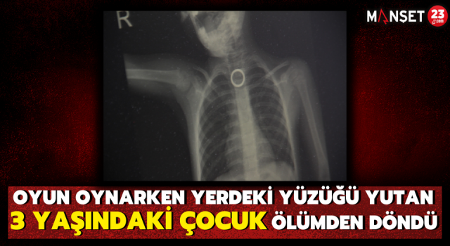 Oyun Oynarken Yerdeki Yüzüğü Yutan 3 Yaşındaki Çocuk Ölümden Döndü